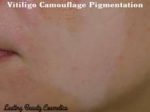 Vitiligo Camouflage