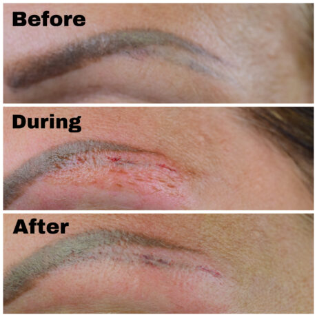 Tattoo removal near me