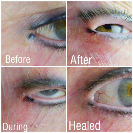 Eyeliner Tattoo Removal