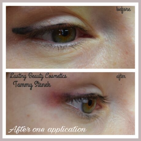 Eyeliner Tattoo removal Madison Wi